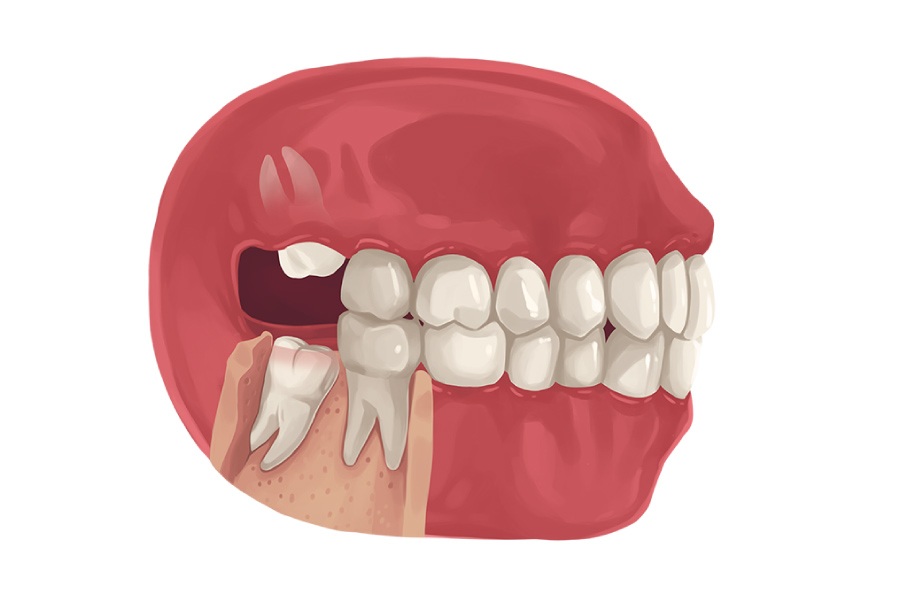 Why Are My Wisdom Teeth Growing In Sideways Hillstream Dental